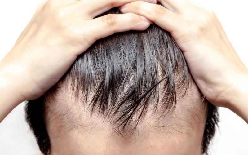 பேன், பொடுகு, வழுக்கை, இளநரைப் பிரச்சினைகளுக்குத் தீர்வு! 1 பேன், பொடுகு, வழுக்கை, இளநரைப் பிரச்சினைகளுக்குத் தீர்வு!